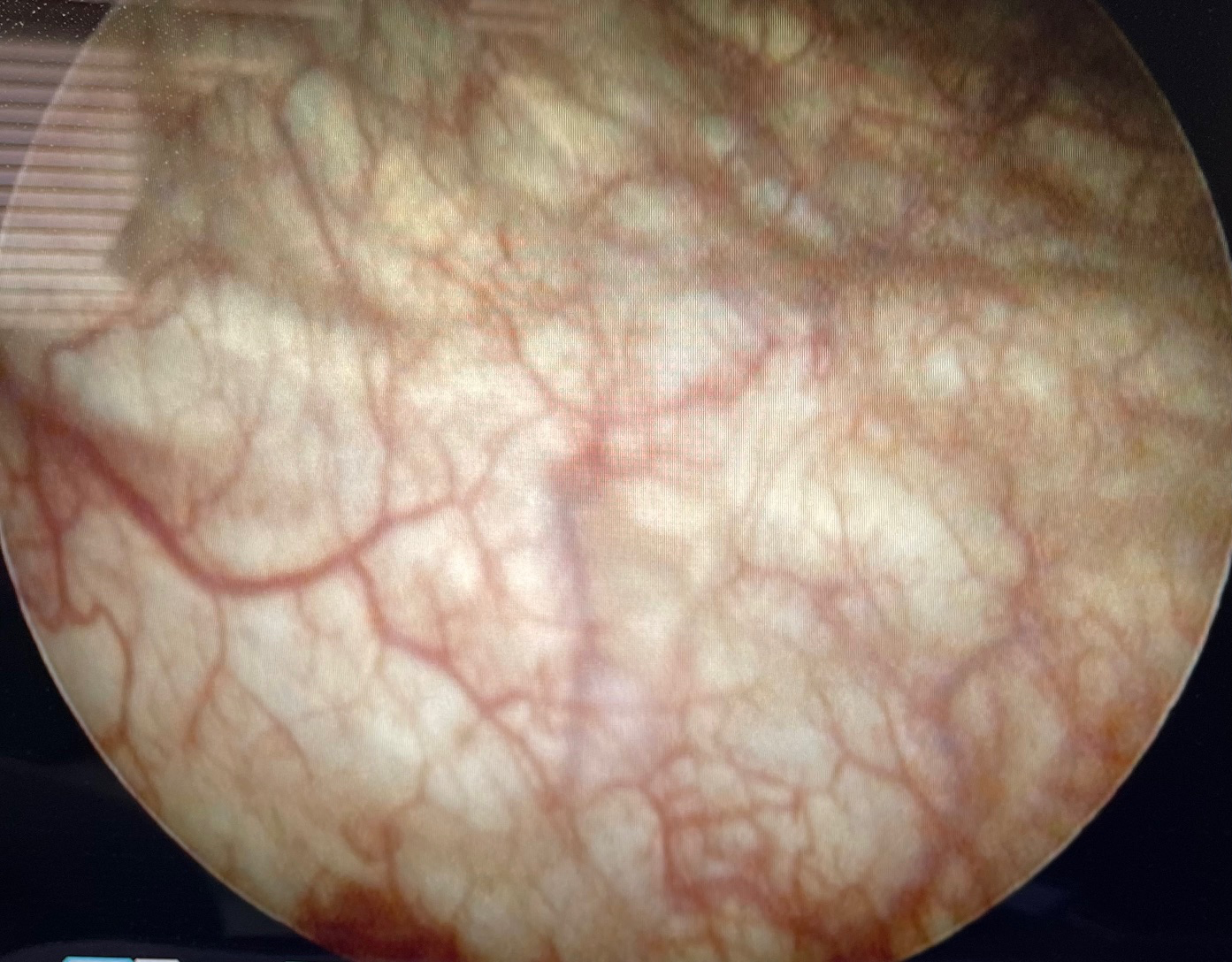 bpc 157 for interstitial cystitis Effect of BPC-157 on Symptoms in Patients with Interstitial Cystitis: A  Pilot Study main image 0